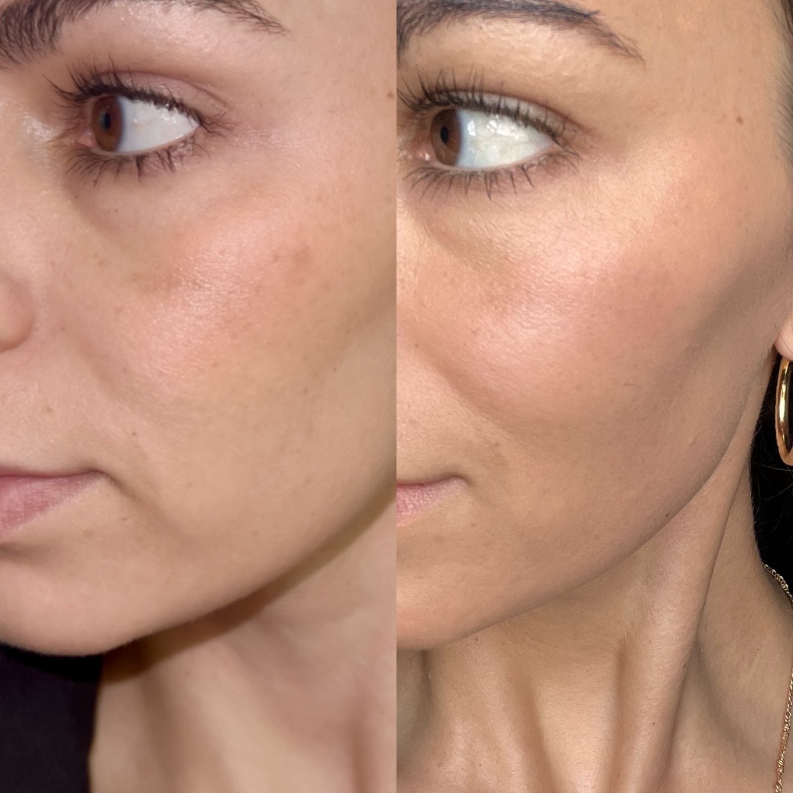 Cheek before (left) and after (right)
