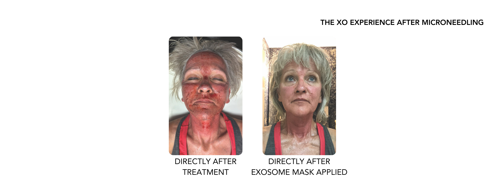 Woman's results after microneedling and applying exosome facial mask afterward. 