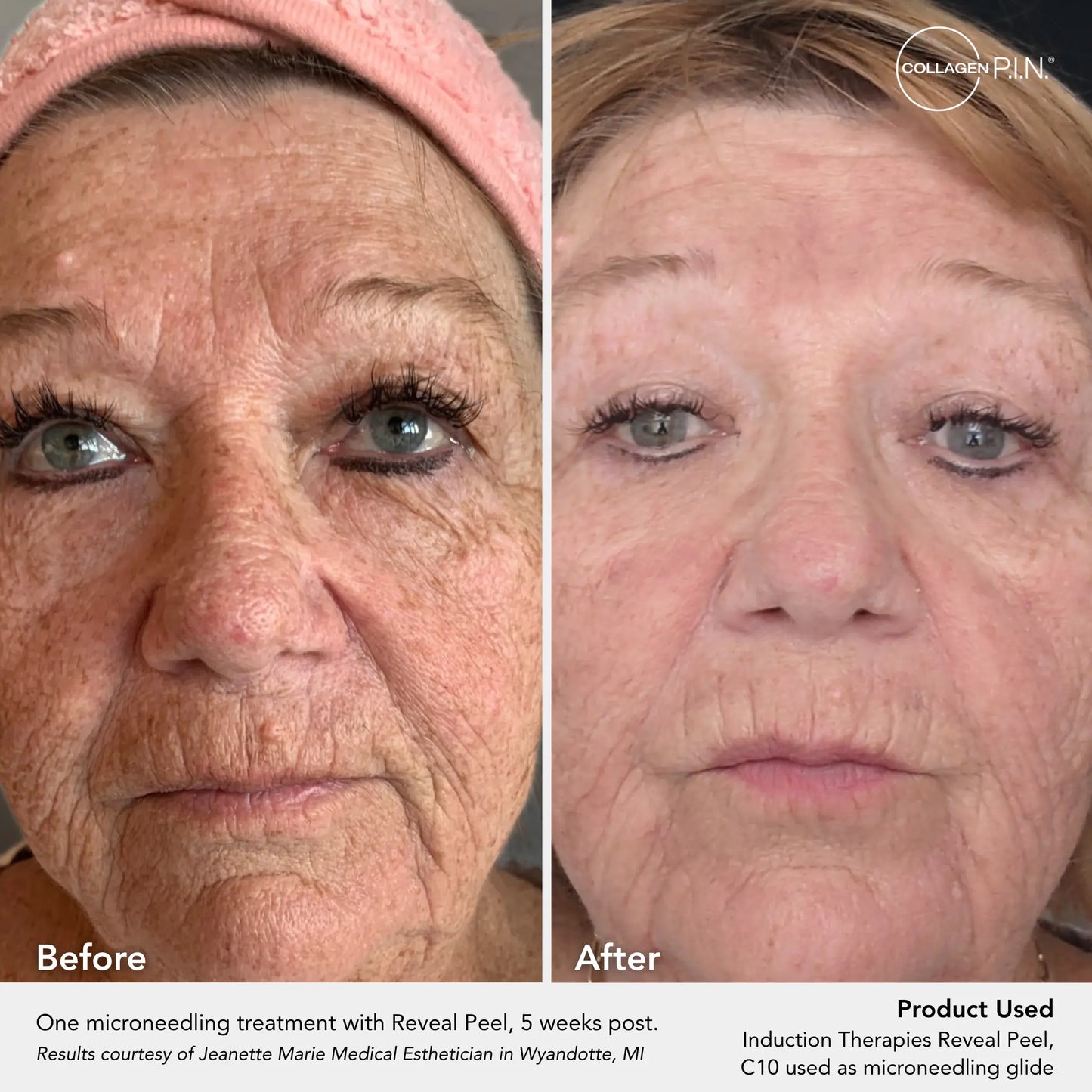 Reveal Peel TCA Peel Pads