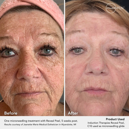 Reveal Peel TCA Peel Pads