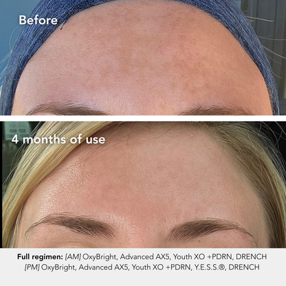 Before and after comparison of a woman's forehead with text indicating 4 months of use and product names.