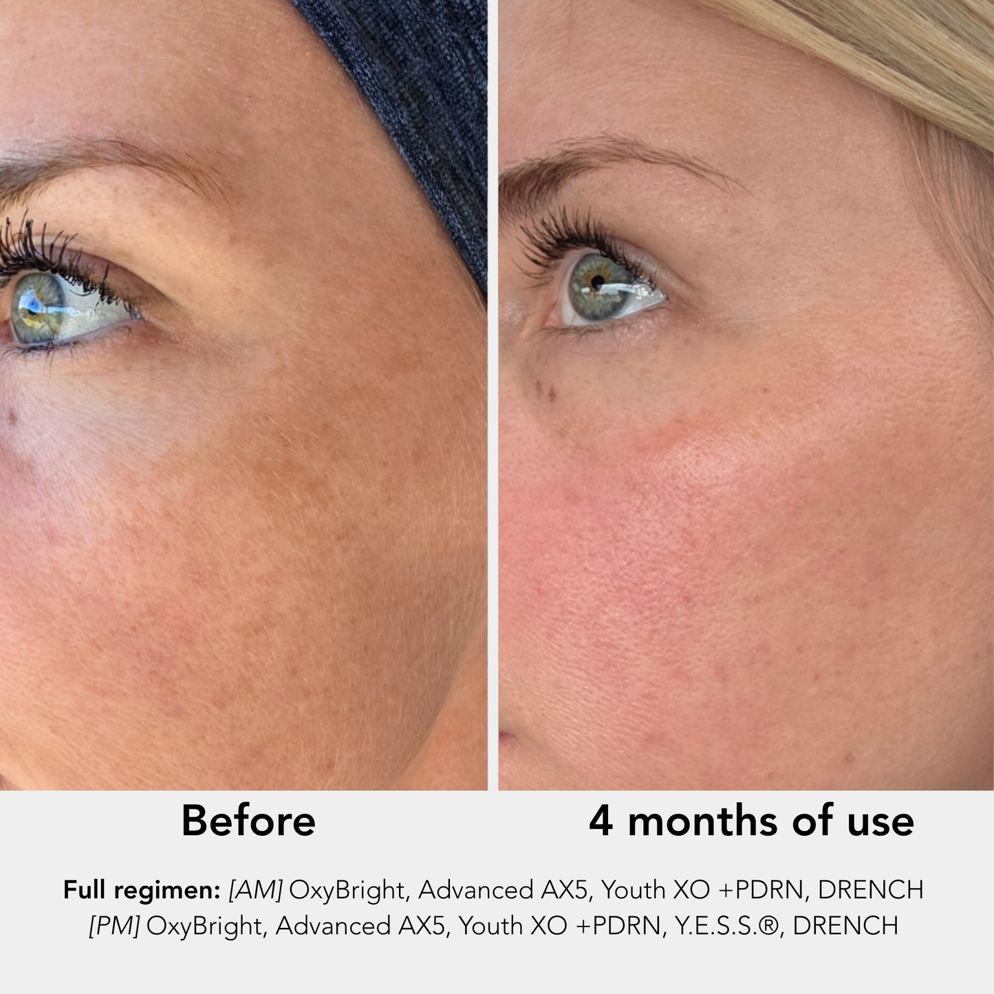 Before and after comparison of skin treatment with product names listed.