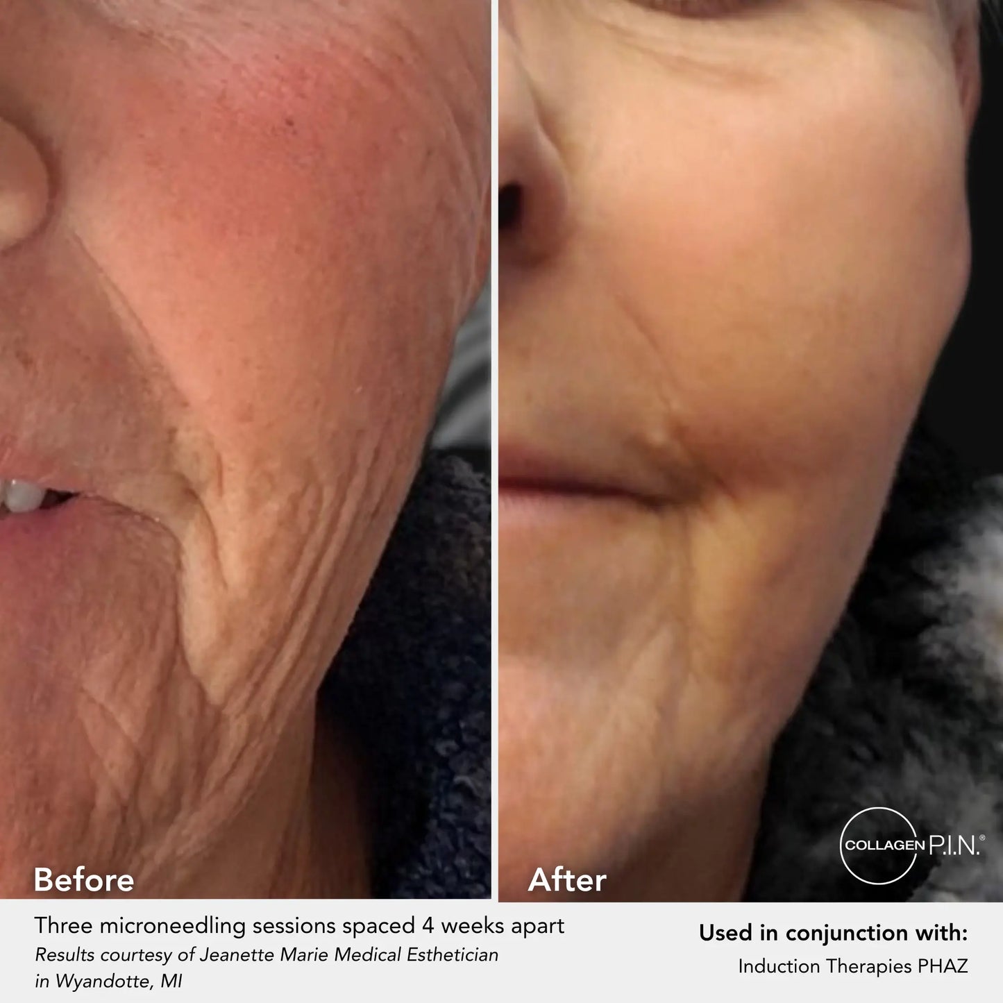 PHAZ - Post Microneedling Serum with Hyaluronic Acid Complex