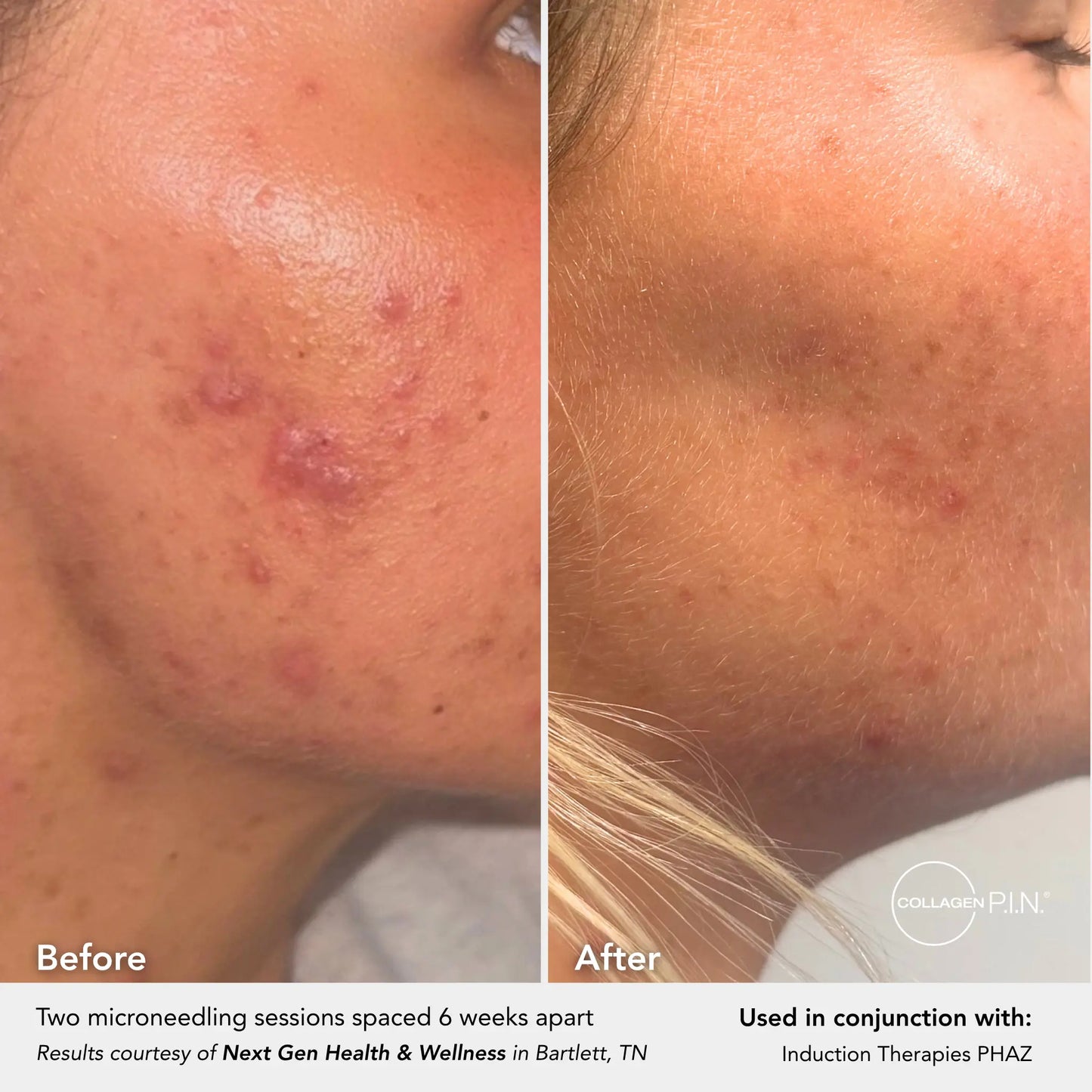 PHAZ - Post Microneedling Serum with Hyaluronic Acid Complex