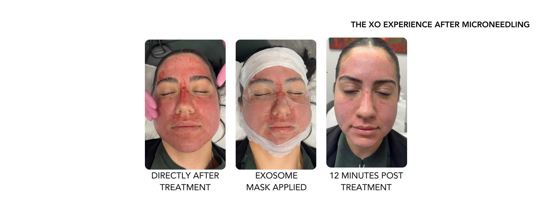 Woman's results after microneedling and applying exosome facial mask after treatment