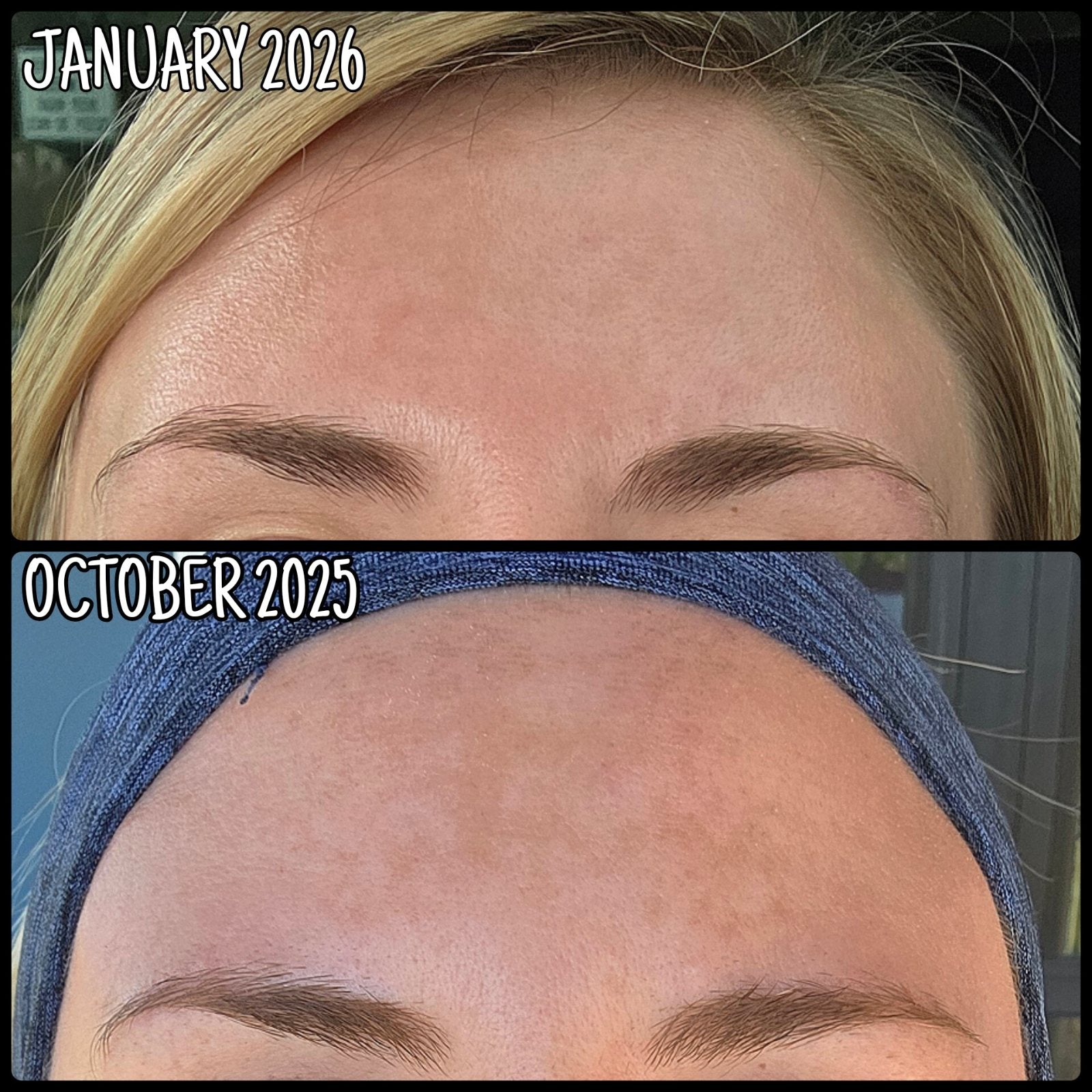 Forehead in January 2026 (top) and October 2025 (bottom)