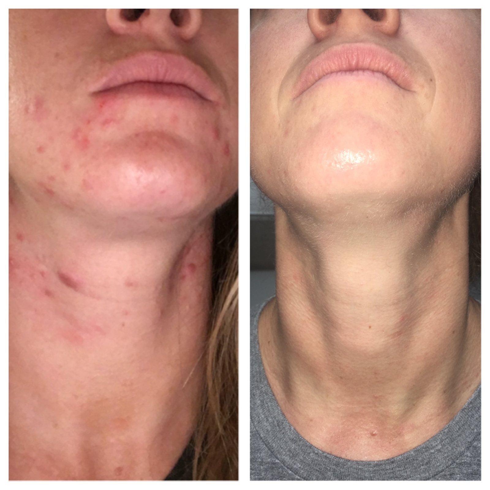 Chin, jaw and neck before and after three months