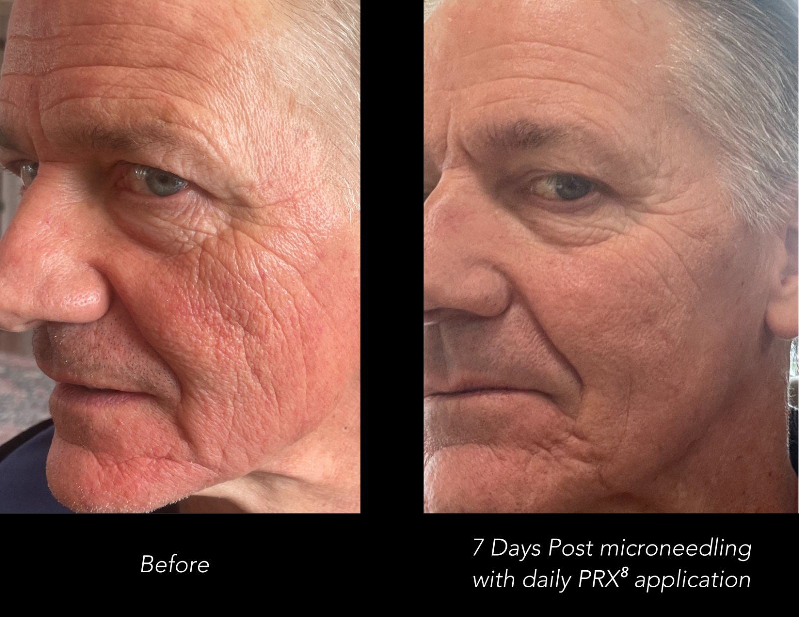 Before, and 7 days after microneedling with daily PRX8