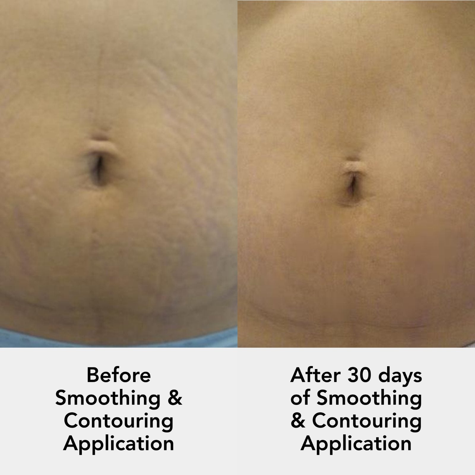 Abdomen before and after 30 days of Smoothing and Contouring Cream