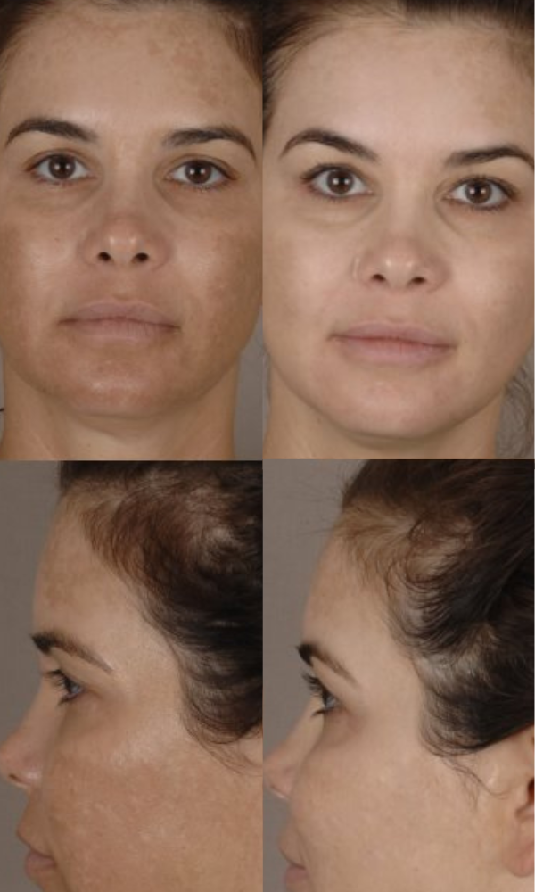 Results achieved in conjunction with microneedling