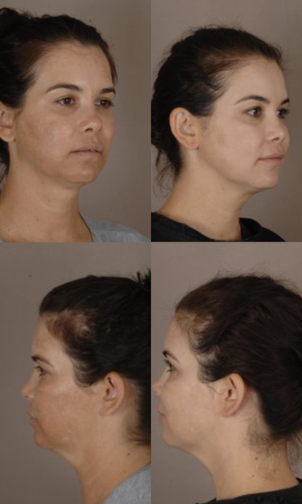 Results achieved in conjunction with microneedling