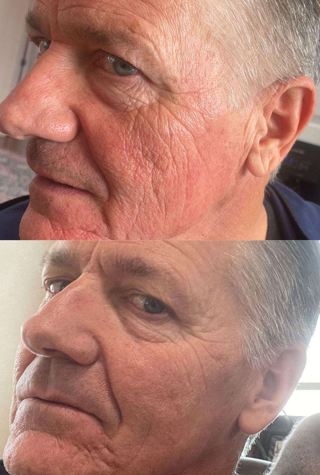 7 days post microneedling with daily PRX⁸ application