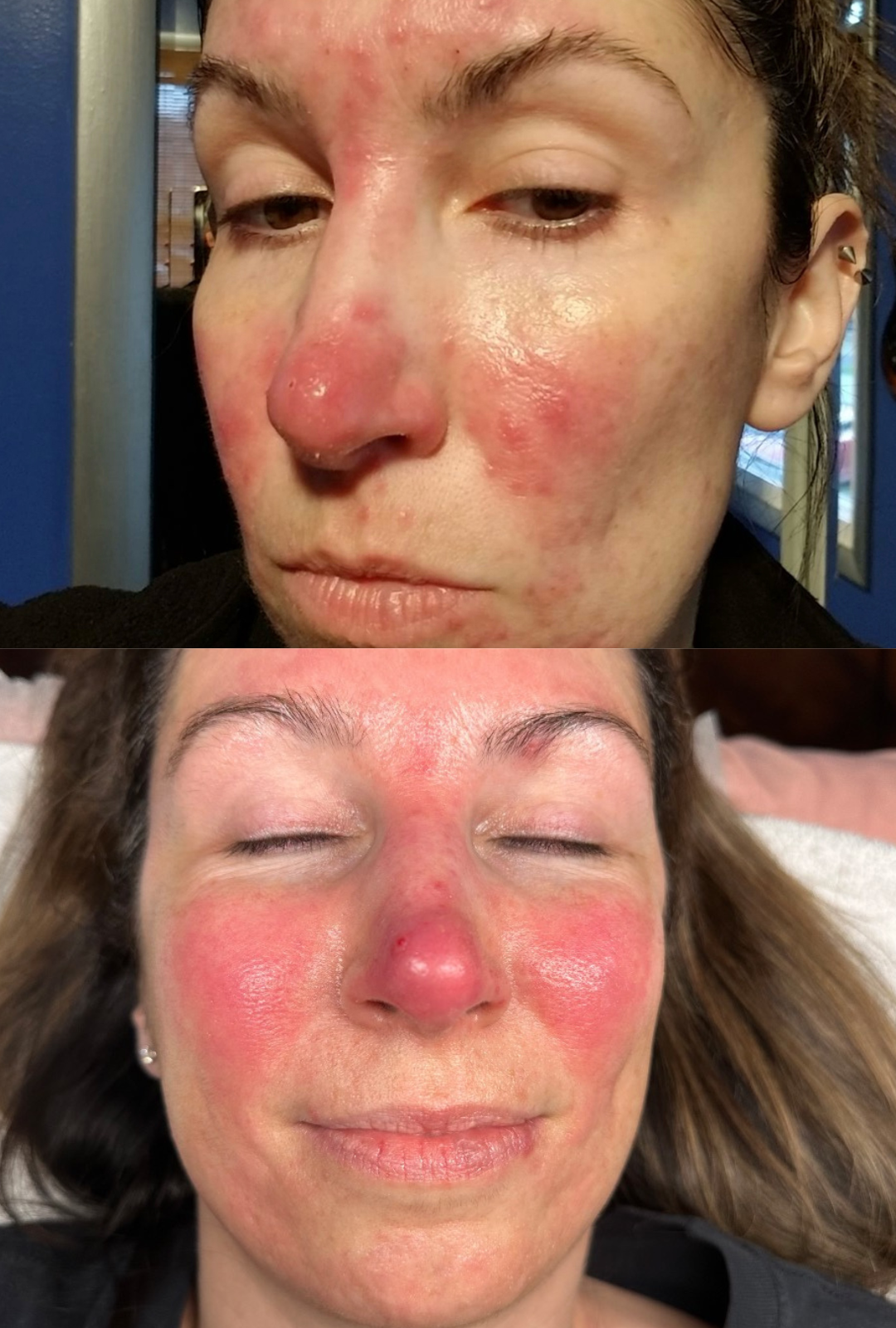 30 days post P.R.R. 4.0% Peel  with daily PRX⁸ application