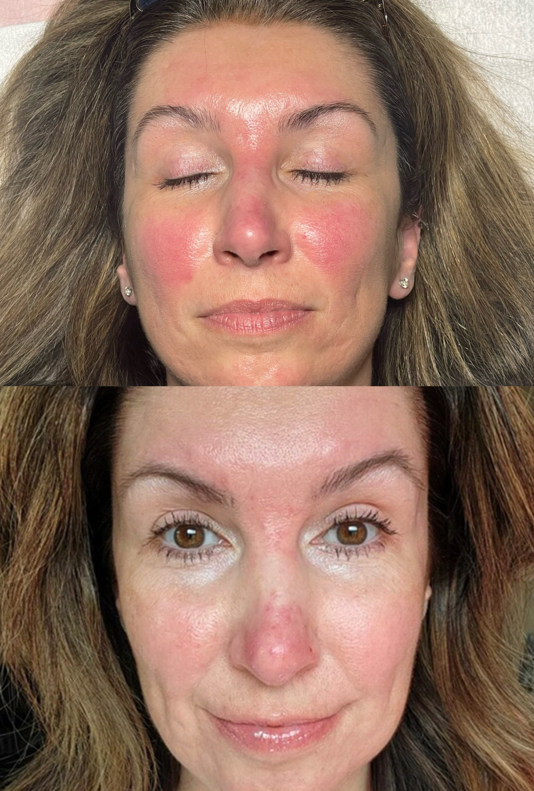 60 days post P.R.R. 4.0% Peel with daily PRX⁸ application