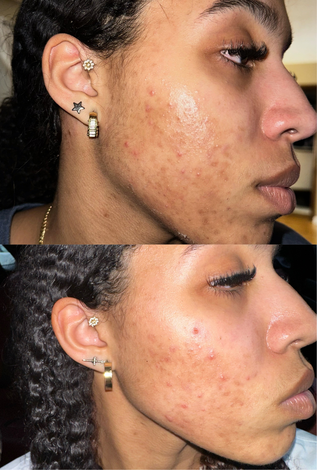 7 days post microneedling with daily PRX⁸ application