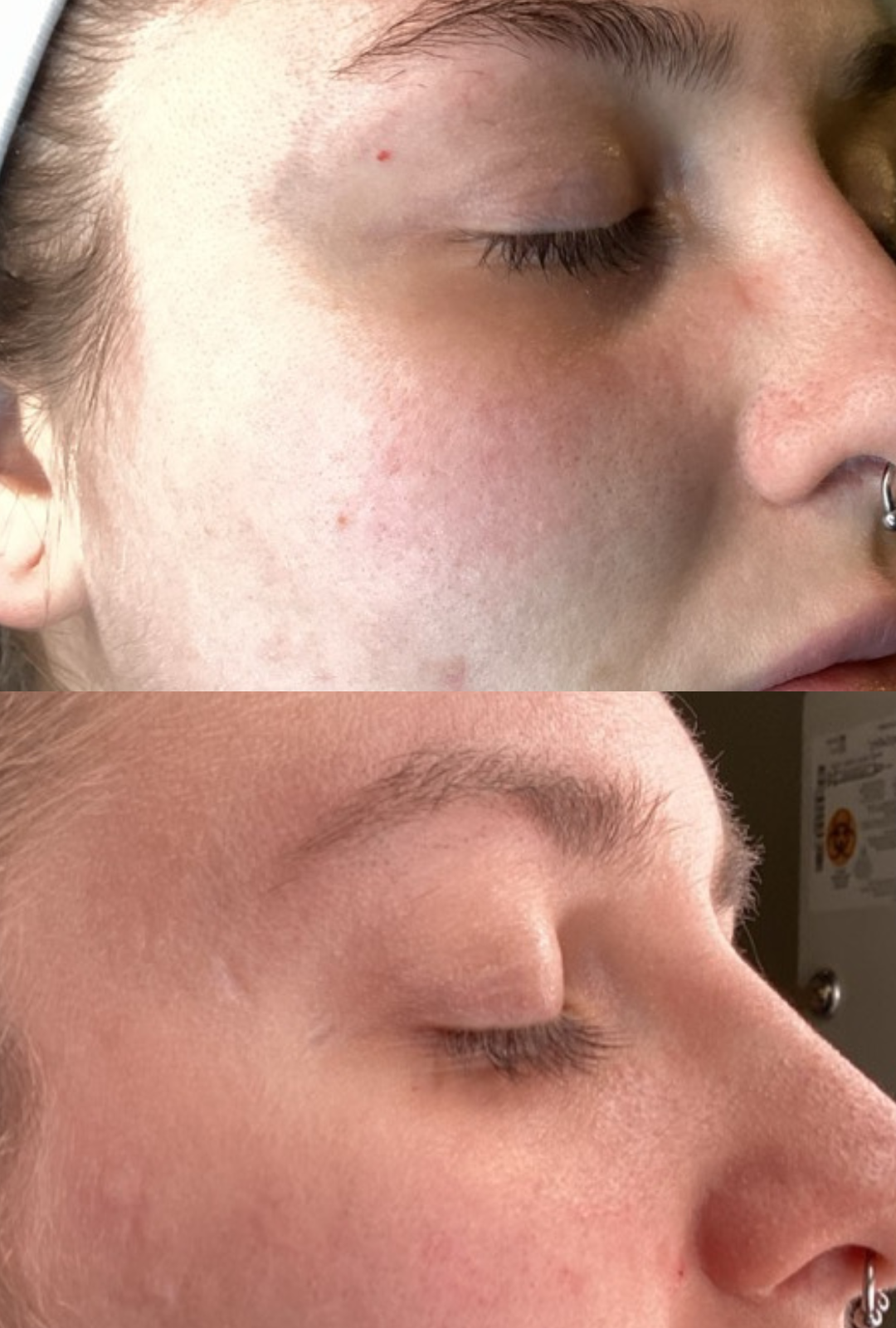 2 weeks post microneedling with daily PRX⁸ application